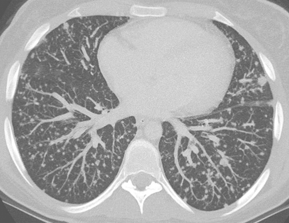 一例多灶微结节性肺泡上皮增生的诊治经验分享
