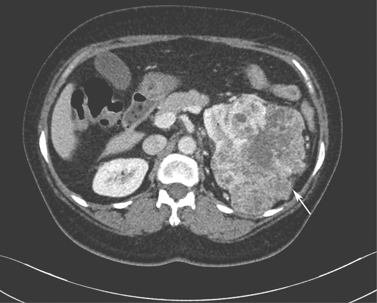 一例少见的伴发肾癌的GIST诊治经验分享
