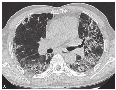 一例抗Jo-1抗体综合征合并干燥综合征伴间质性肺炎的诊治经验分享