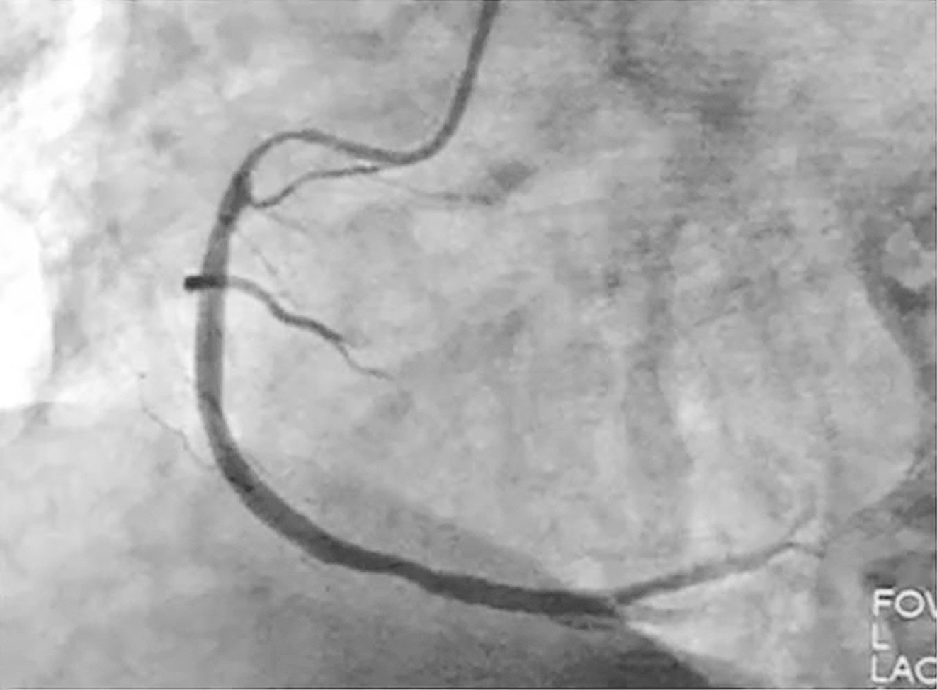 一例高龄（＞80岁）胃肠道间质瘤的诊治经验分享
