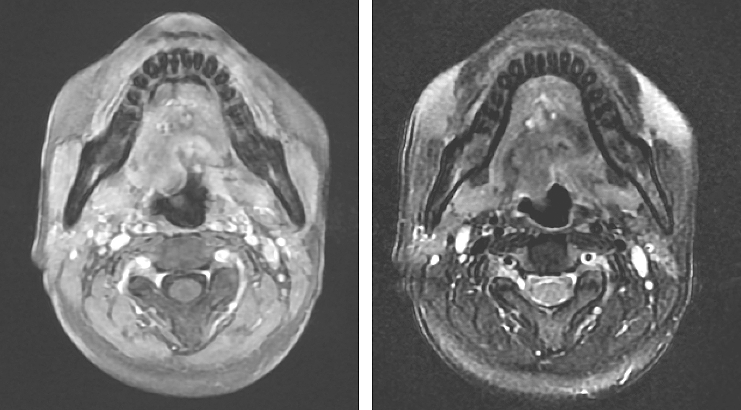 一例舌根腺样囊性癌的诊治经验分享
