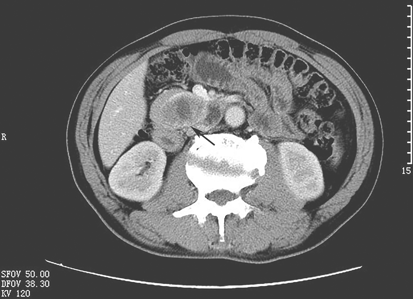 一例GIST辅助治疗期间发生疾病进展病例诊治经验分享