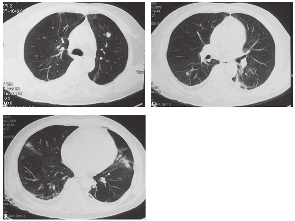 一例肺诺卡菌病患者的诊疗思辨