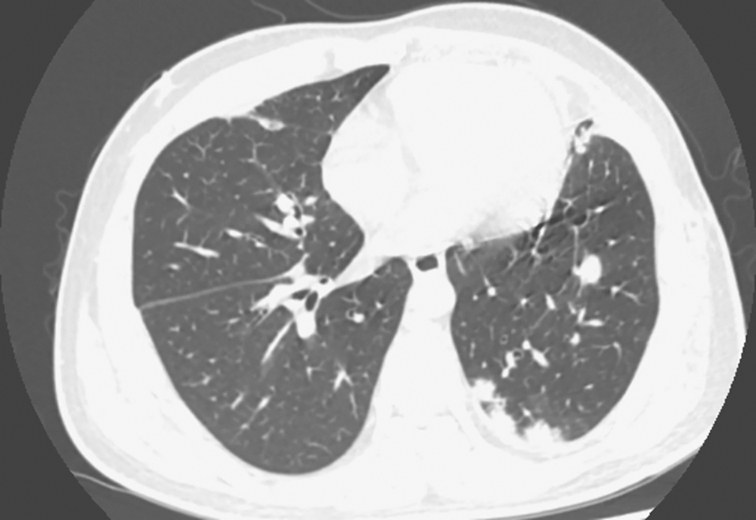 一例马红球菌肺炎的临床诊疗思辨
