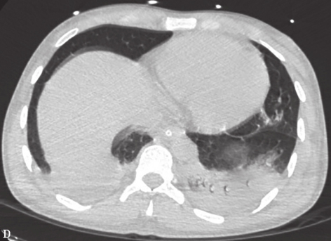 一例鼻病毒肺炎合并肺炎链球菌肺炎诊治经验分享
