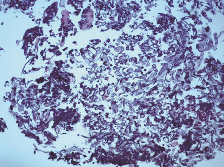 一例表现为咳嗽、咯血伴肺部肿块影的肺毛霉菌感染疑难病例解析