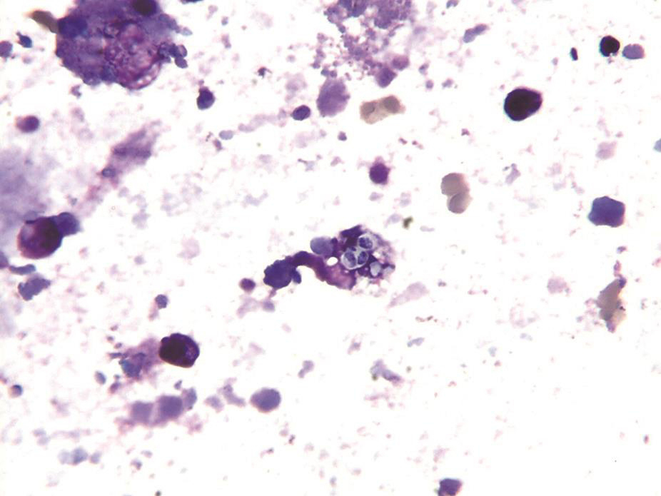 一例侵袭性肺部真菌感染诊治经验分享