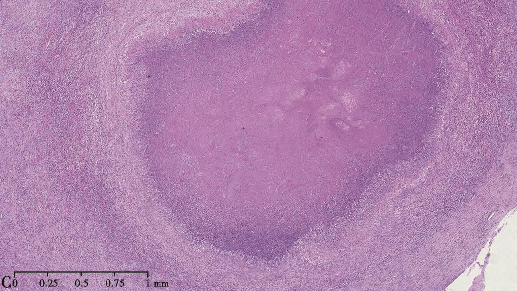 一例肺组织胞浆菌病诊治经验分享
