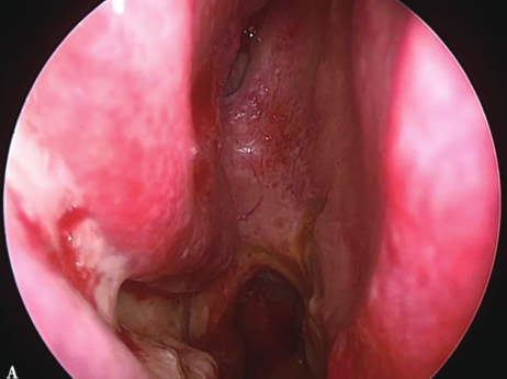 王任直、邓侃、姚勇、包新杰：神经内镜下经鼻蝶窦入路手术