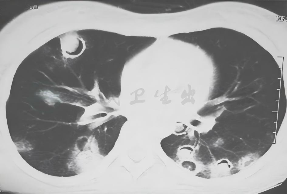 一例隐源性机化性肺炎诊治经验分享