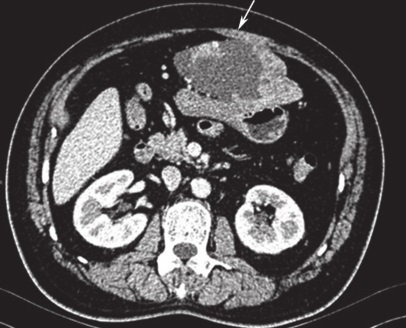 一例D842V突变型胃肠间质瘤的诊治经验分享