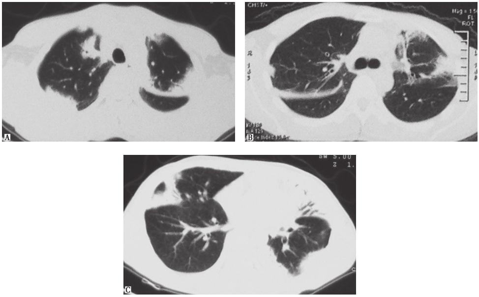 一例表现为咳嗽、发热、肺部多发实变影的隐源性机化性肺炎诊治经验分享