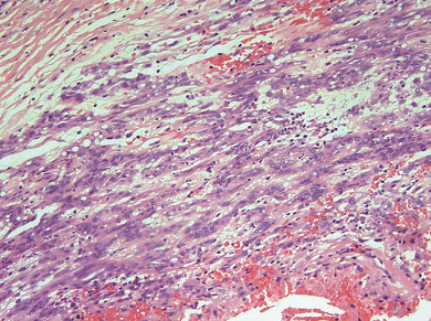 一例腹腔巨大囊性胃肠间质瘤（GIST）诊治经验分享