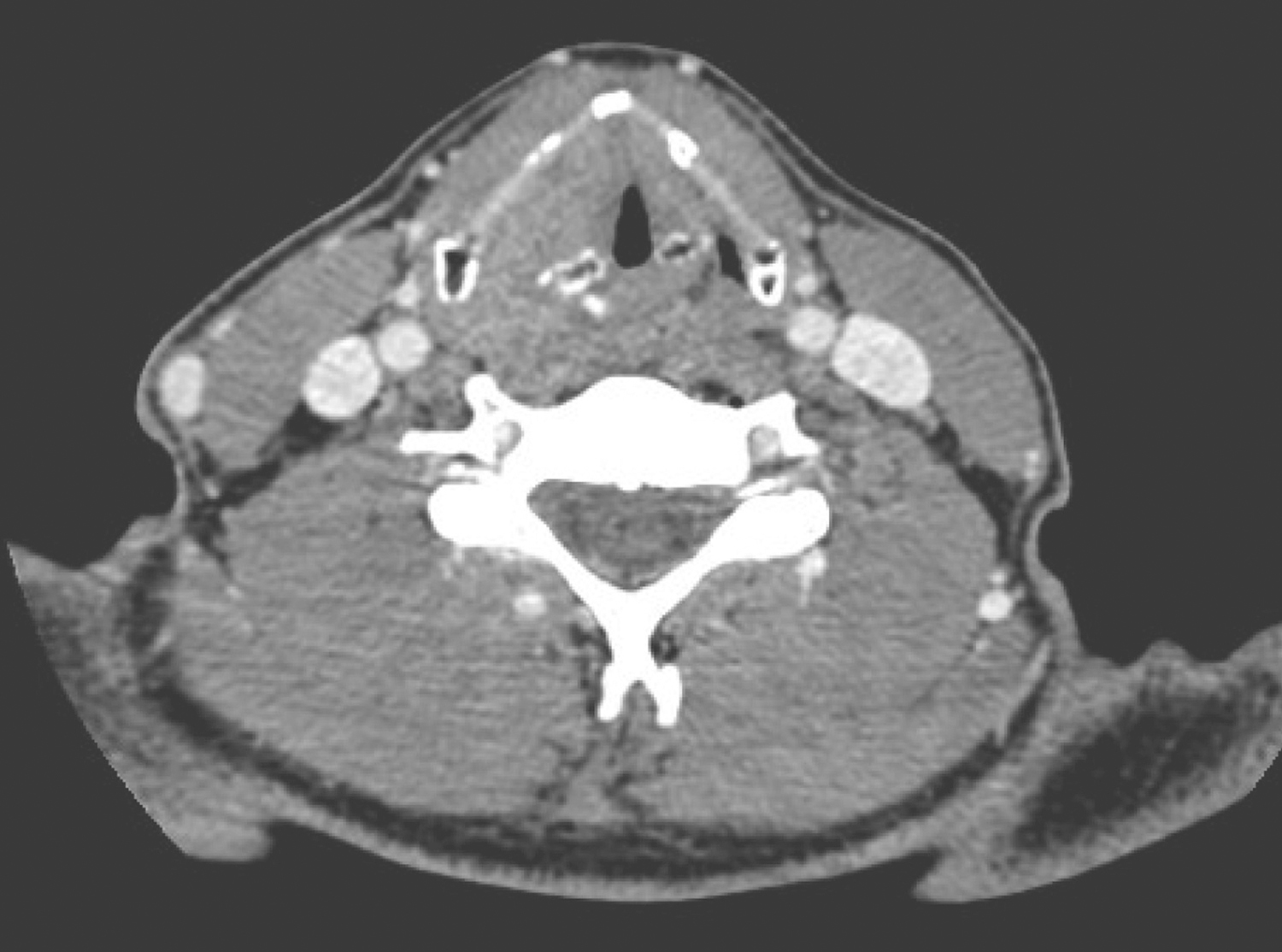 一例下咽癌右颈淋巴结转移诊治经验分享