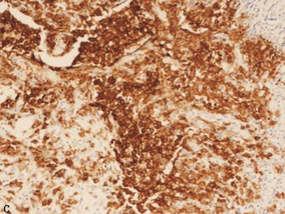 一例肺朗格汉斯细胞组织细胞增生症诊治经验分享